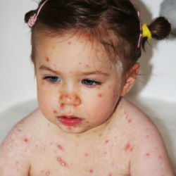 Where can you find pictures of children with rashes?